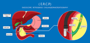 Gallstone removal combined with bile duct Stent replacement by endoscopic reverse cholangiopancreatography (ERCP) at FV hospital