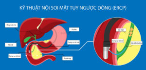 Lấy sỏi kết hợp đặt Stent ống mật bằng kỹ thuật nội soi mật tụy ngược dòng (ERCP) tại Bệnh viện FV