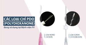 Giảm cân bằng Phương pháp cấy chỉ – An toàn, Hiệu quả