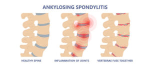 Avoid disability due to ankylosing spondylitis with targeted therapy with biological drugs at FV
