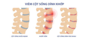 Thoát khỏi tàn phế do viêm cột sống dính khớp bằng thuốc điều trị sinh học tại FV