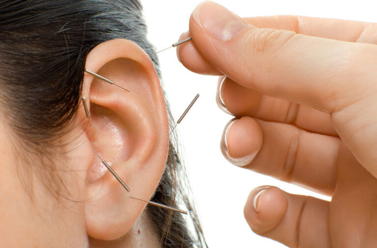 Acupuncture