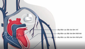Cứu sống bệnh nhân suy tim nặng nhờ vào tiến bộ khoa học kỹ thuật trong y học