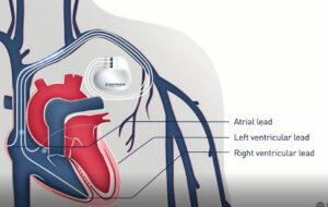 FV Doctors save the life of a patient with serious heart failure using advanced technology and scientific developments in medicine