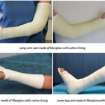Care of Casts and Splints