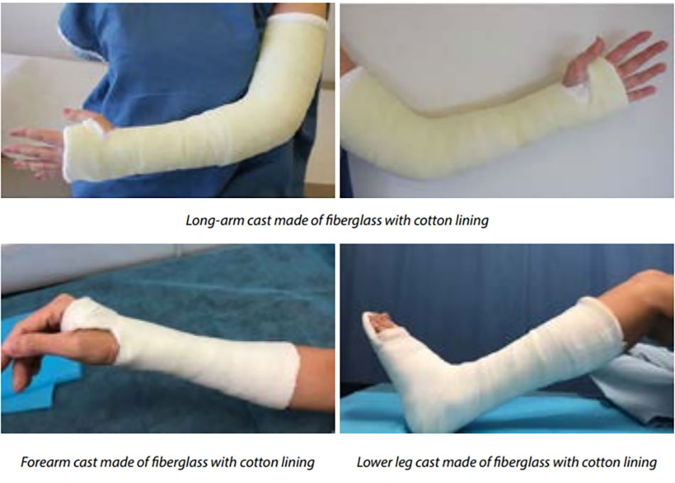 care of casts and splints