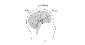 Growth Hormone Deficiency