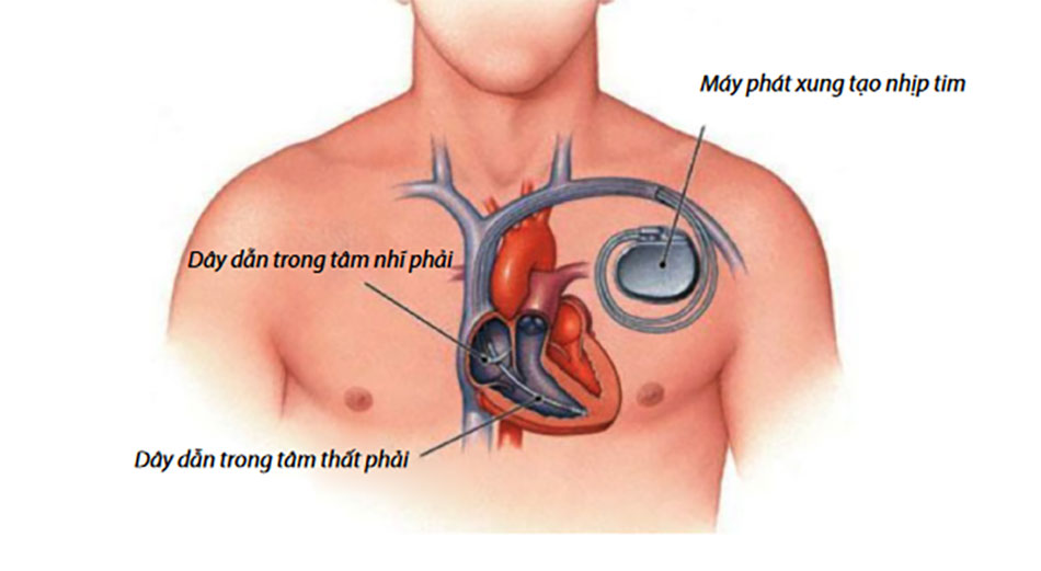 may-tao-nhip-tim-nhat-ban