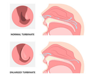 Treatment of Nasal Turbinate Hypertrophy via High Frequency CURIS® Technique at FV: Safe, Less Invasive, a Shorter Recovery Period