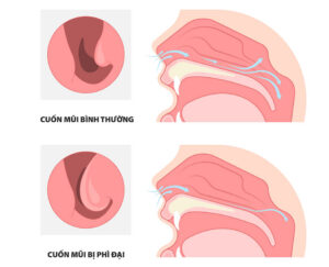 Điều trị phì đại cuốn mũi dưới bằng sóng cao tần an toàn, ít xâm lấn, mau phục hồi tại FV