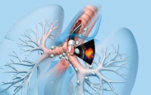FV Implements Endobronchial Ultrasound Technique To Help Diagnose Early And Accurate Stage Of Lung Cancer