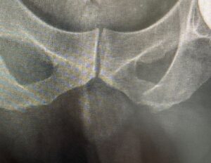 Joint replacement without a drainage tube: Less pain after surgery, patients can begin physical therapy within a day