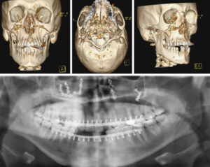 Turkish patient with multiple facial injuries is successfully treated at FV