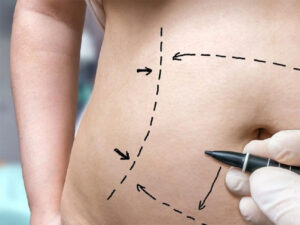 Abdominoplasty with liposuction at FV Lifestyle can help you to regain a slim, smooth body contour