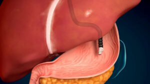 Endoscopic Ultrasound (EUS): A new advancement in screening and therapeutic support for gastrointestinal disorders