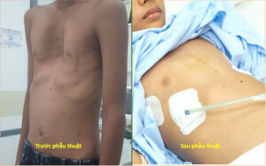 Charitable surgery to repair a severely sunken chest for a 9-year-old boy