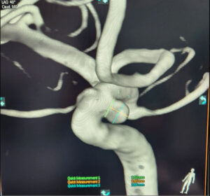 Brain aneurysms can be treated with endovascular intervention