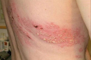 Patient Suffers from Post-herpetic Neuralgia, Pain Following Shingles, for 25 Years After Missing the Optimal Period for Treatment