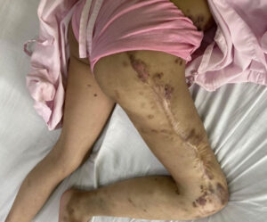 A Life-Changing Surgery for a Young Cambodian Girl and Her Mother