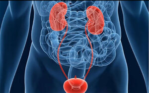 A Tiny Amount of Blood in Urine Is Warning to Be Screened for Bladder Cancer
