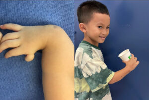 The Journey of ‘Hand Restoration’ for a Boy with Radial Bone and Thumb Hypoplasia Syndrome
