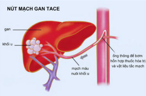 Điều trị ung thư gan bằng phương pháp can thiệp nội mạch cho cụ ông u90