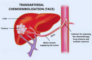 Liver Cancer Treatment with Transarterial Chemoembolisation (Tace) for a 90-Year-Old Man