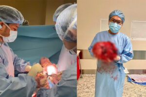 Baby Wrapped in 8 kg Fibroid Born Healthy at FV Hospital