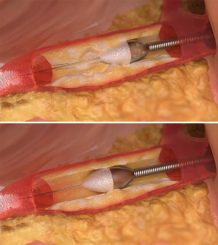 FV Hospital uses diamond drill to treat calcified coronary artery for ...