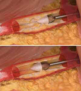 FV Hospital uses diamond drill to treat calcified coronary artery for the first time, avoiding open surgery