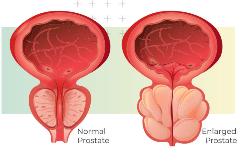 Prostate Artery Embolisation for Benign Prostatic Hyperplasia