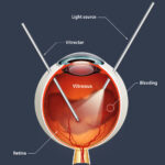 Vitrectomy