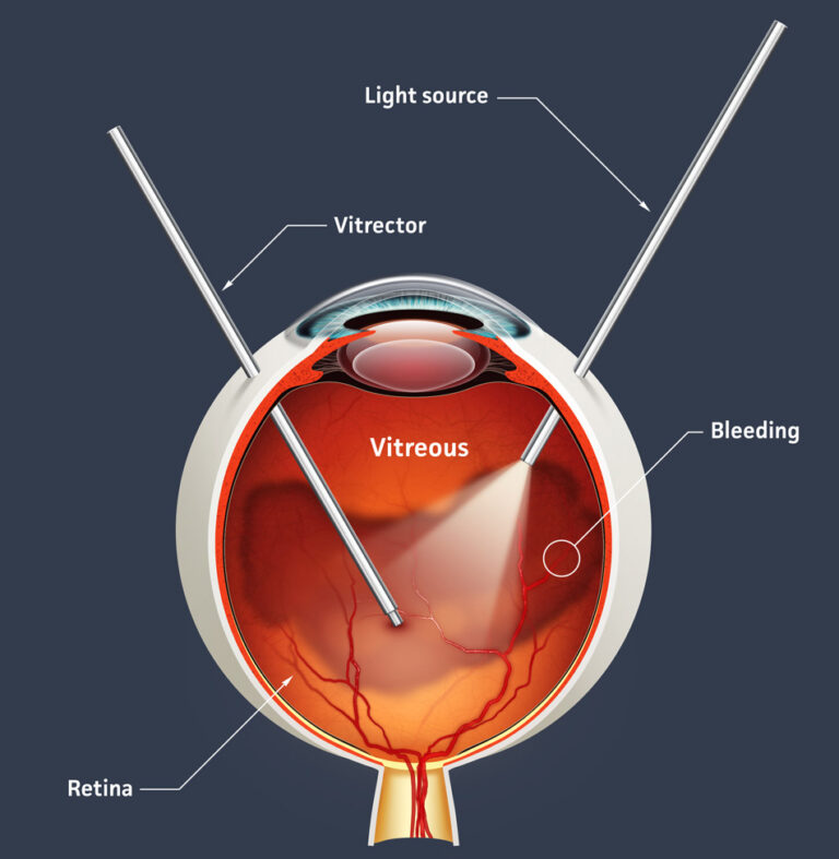 Vitrectomy