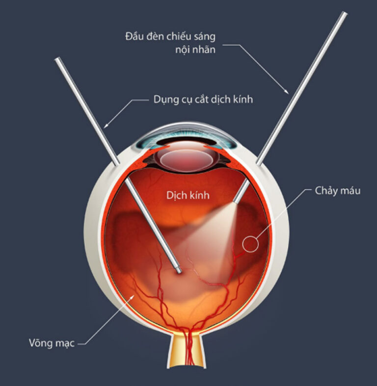 Phẫu thuật cắt dịch kính