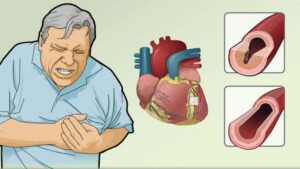 7 Dấu Hiệu Bệnh Tim Mạch Cần Chú Ý Ngay Từ Bây Giờ
