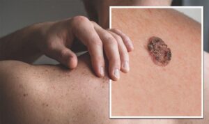 Cảnh báo mới nhất về 9 dấu hiệu của ung thư da ít ai ngờ đến