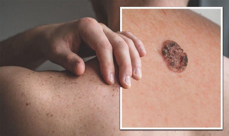 Cảnh báo mới nhất về 9 dấu hiệu của ung thư da ít ai ngờ đến