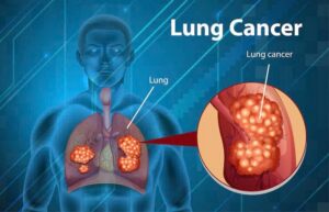 Dấu hiệu của ung thư phổi là gì? Làm sao để nhận biết ung thư phổi sớm nhất?