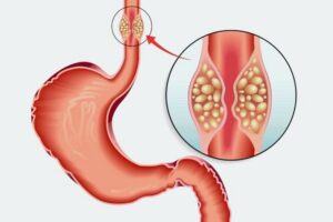 Dấu Hiệu Ung Thư Thực Quản: Nhận Biết Sớm – Dễ Điều Trị