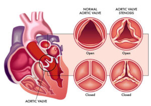 FV Hospital leads the way in advanced aortic valve replacement technology