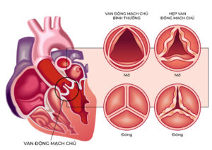 Bệnh viện FV tiên phong ứng dụng công nghệ thay van động mạch chủ thế hệ mới nhất