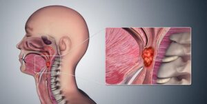 7 nguyên nhân ung thư vòm họng ít ai ngờ đến