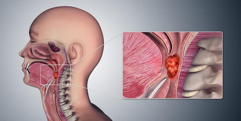 7 nguyên nhân ung thư vòm họng ít ai ngờ đến