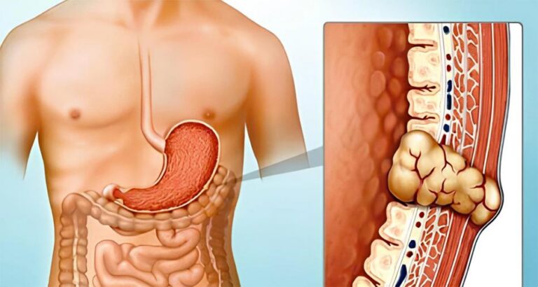 Ung thư di căn là gì? Ung thư di căn có chữa được không?