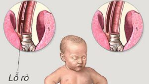 Cách phân loại các bệnh về đường tiêu hóa