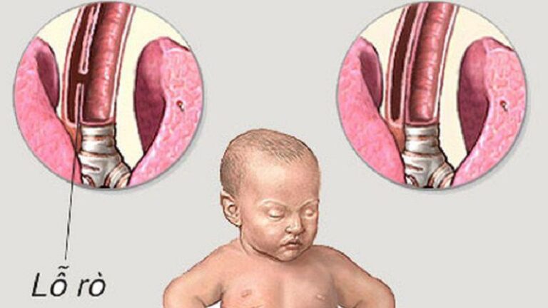 Cách phân loại các bệnh về đường tiêu hóa