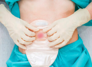 Rectal perforation during cosmetic genital surgery