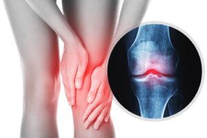 Bệnh xương khớp là gì? Có phải ai cũng sẽ mắc các bệnh về xương khớp?