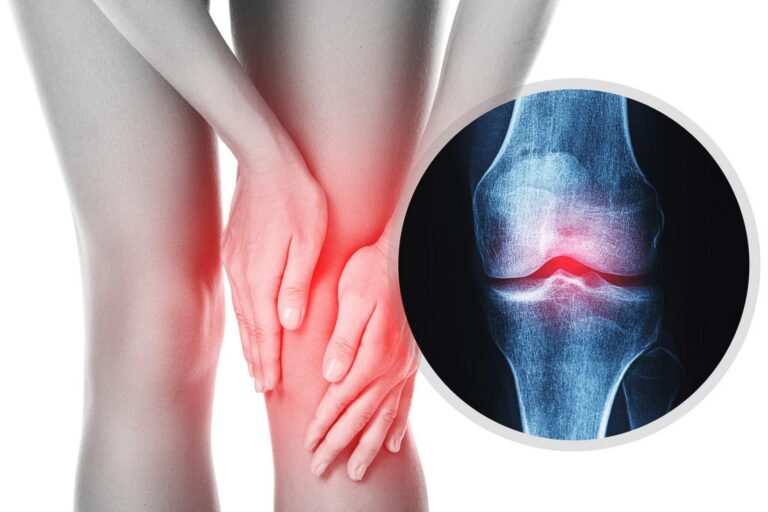 Bệnh xương khớp là gì? Có phải ai cũng sẽ mắc các bệnh về xương khớp?