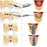 Dental Implant Surgery